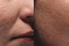 acne2